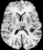 Multiple intraparenchymal hemorrhages in a patient with thrombotic thrombocytopenic purpura